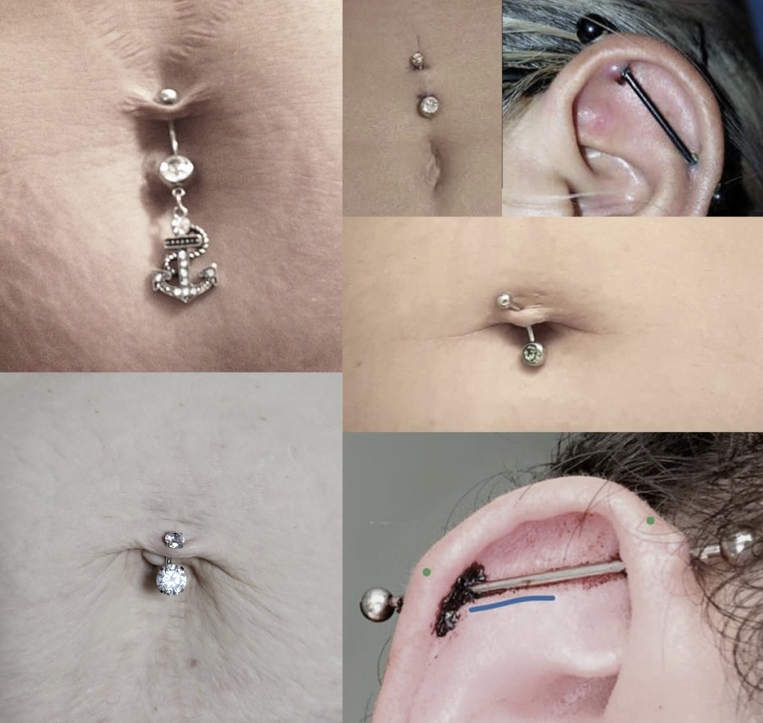Nesprávne aplikované piercingy kvôli nevhodnej anatómii tela.
